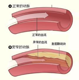 冠狀動脈狹窄