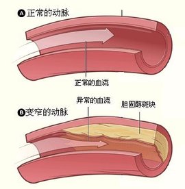 冠狀動脈痙攣