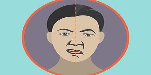 周围面神经麻痹是怎么回事？