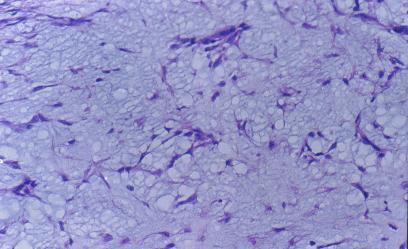 粘液样变图册_360百科