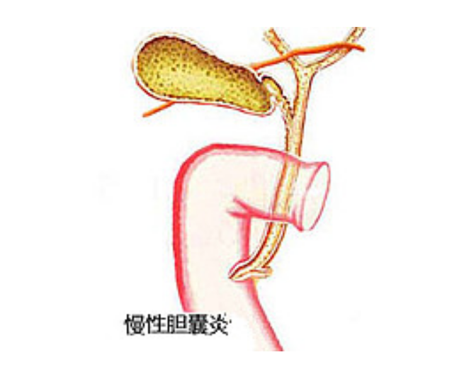 慢性胆囊炎图册_360百科