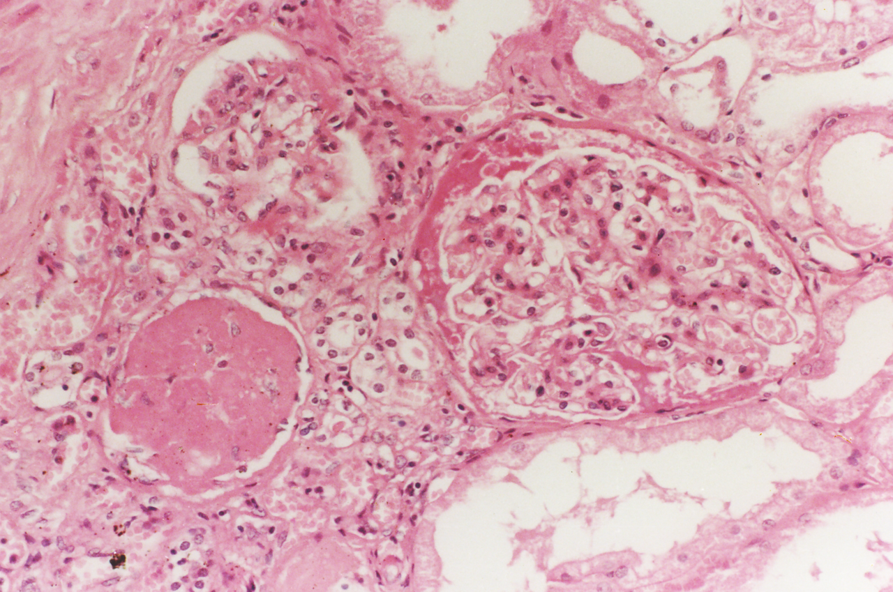 显微镜下肝脏脂肪变性照片摄影图片_ID:312793950-Veer图库