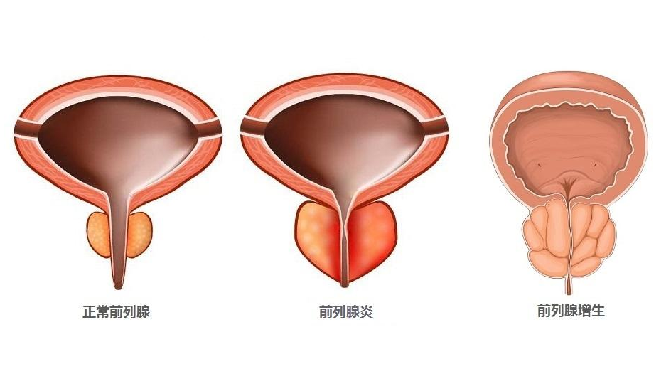 前列腺长什么样子图片图片