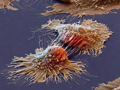 显微镜下的癌细胞是什么样子的?图片