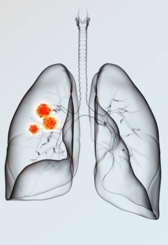 肺癌图册_360百科