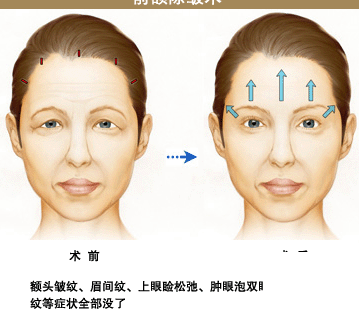额部除皱术图册_360百科