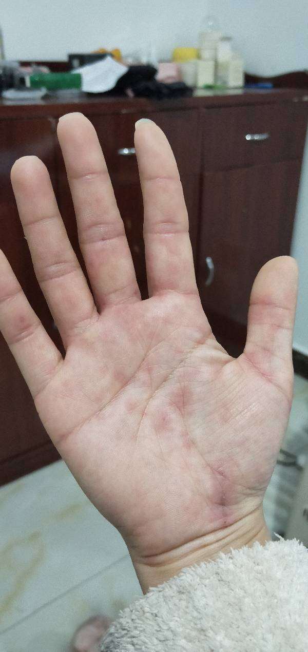 手指和手掌上上有好多小疙瘩，特别痒，是什么原因，怎么办？