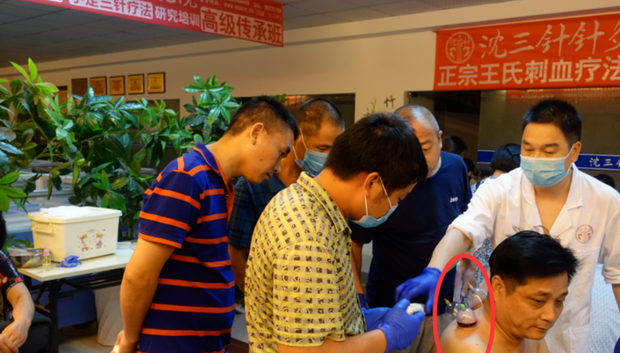 背部中医刺络放血疗法_360新知