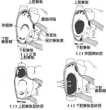 心房间隔缺损图册_360百科