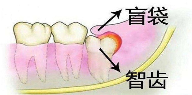 得了智齿冠周炎的怎么办_360新知