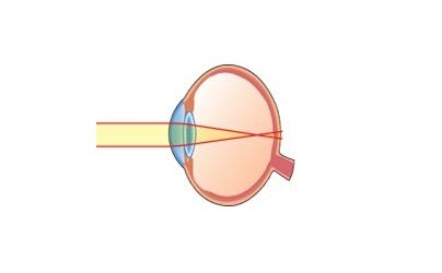 散光眼图册_360百科