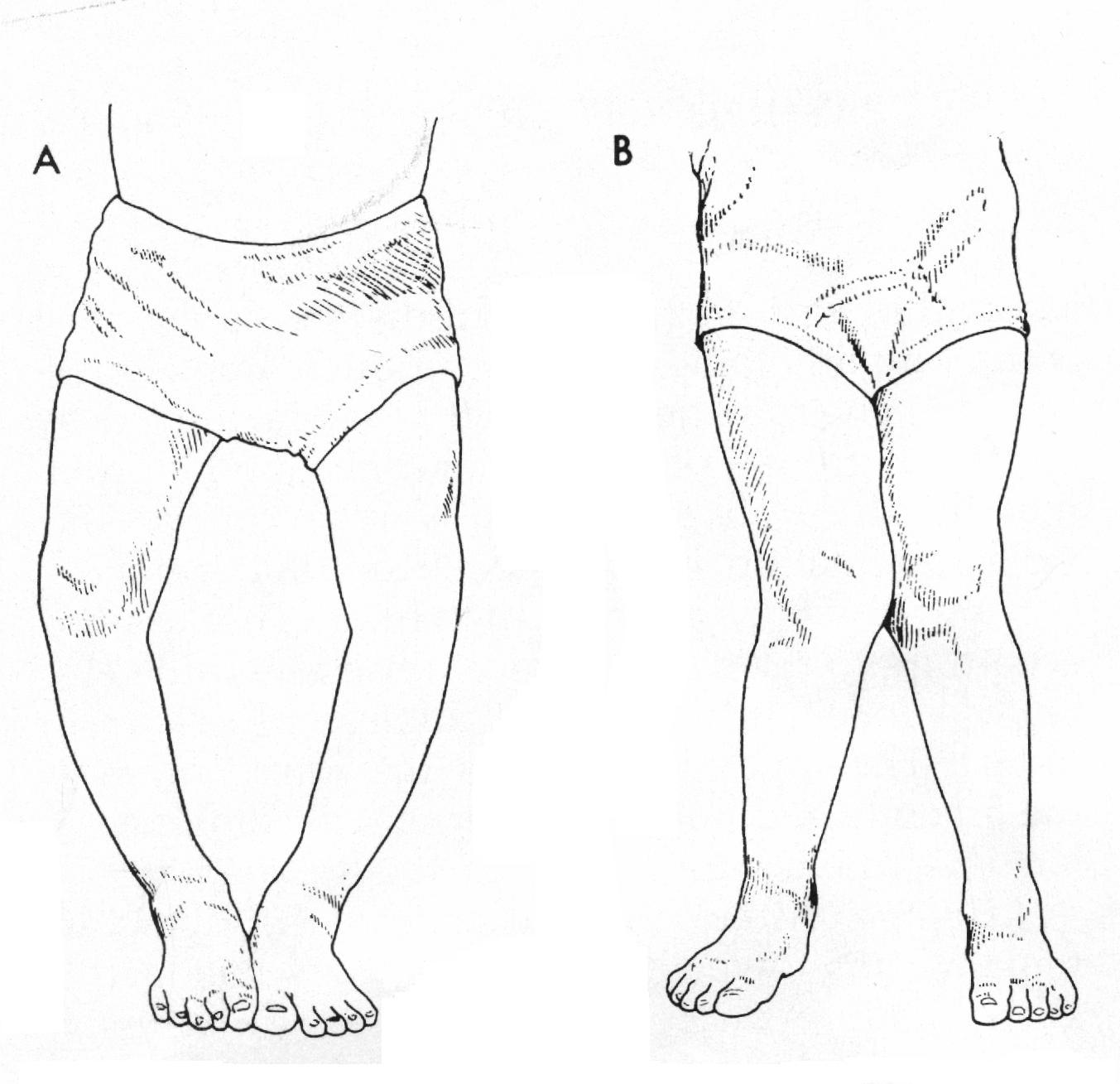 孩子怎麼會有O/X型腿呢？ – KidPro醫學級兒童發展教育團隊