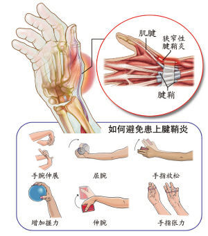 手指腱鞘炎图册_360百科
