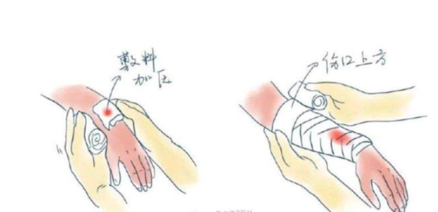 常用的止血方法有几种_360新知