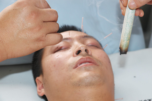 针灸可以治疗青