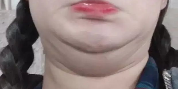 长了双下巴怎么办如何快速消除双下巴360新知 