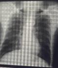 特发性肺纤维化的表现特征