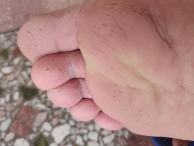 一双脚被真菌感染了要吃什么中药或是涂什么药膏能很快好