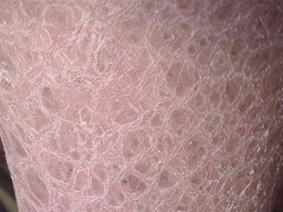 鱼鳞病的危害都有什么 360新知