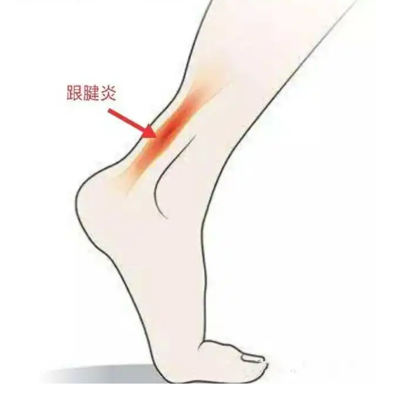 跟腱炎图册_360百科
