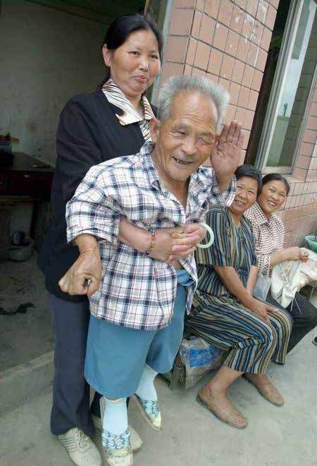 生长激素缺乏性侏儒症图册_360百科