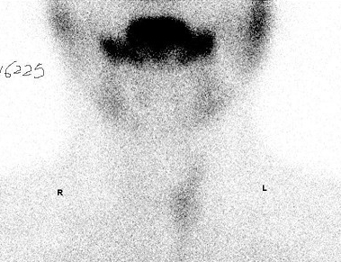 甲状腺显像图册_360百科