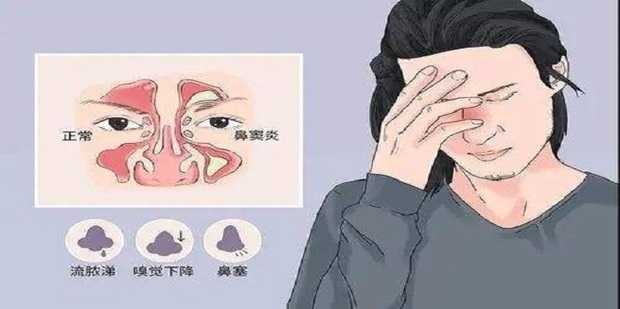 鼻窦炎的最佳治疗方法_360新知