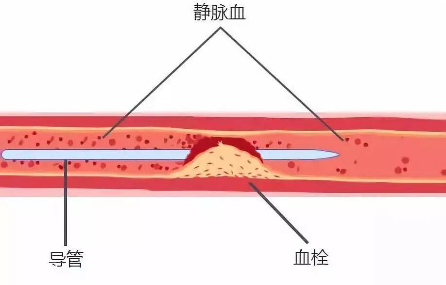 血栓形成图册_360百科