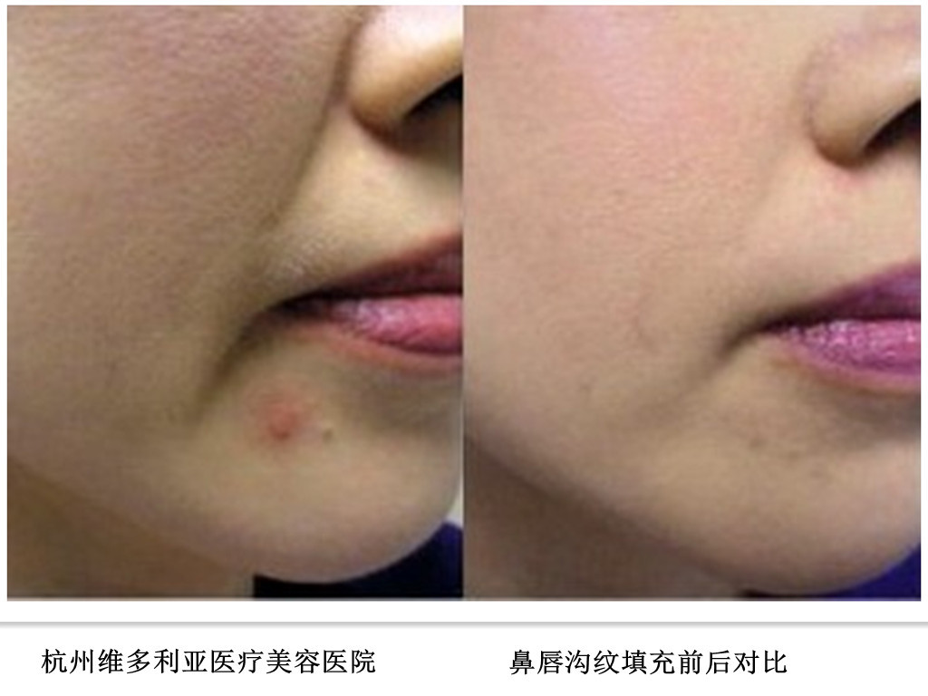 郭鑫医生面部脂肪填充案例一：法令纹（鼻唇沟）填充 - 好大夫在线
