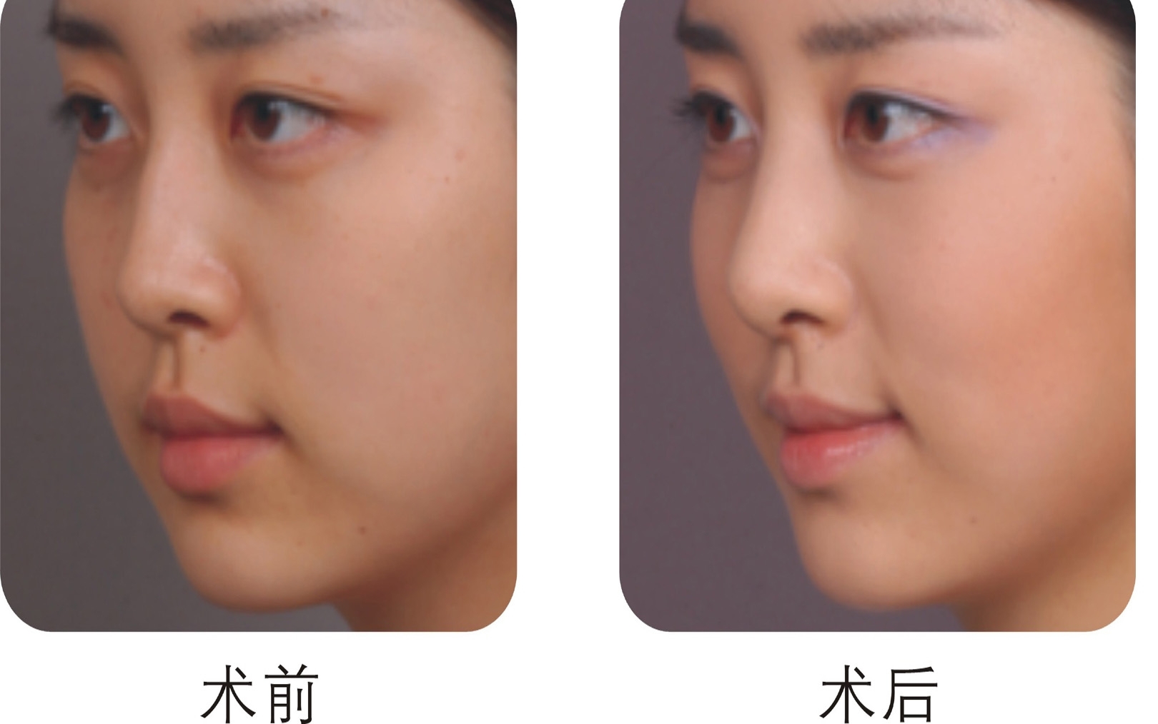 鼻翼挙上の料金や手術方法 |新宿と池袋の美容整形は東京シンデレラ美容外科