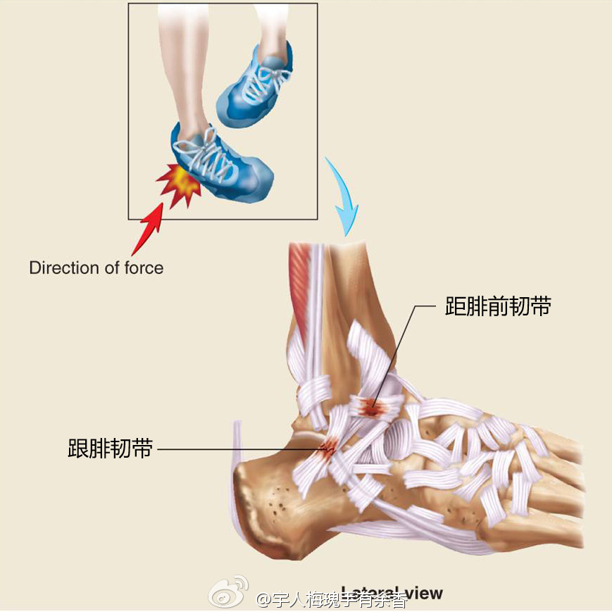 距腓前韧带图册_360百科