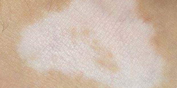 胳膊上有小白点白斑是什么？皮肤病怎么治360新知