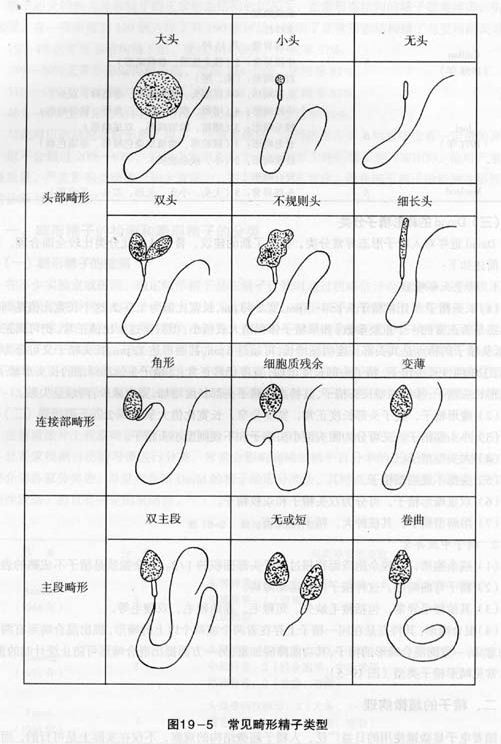 畸形精子症图册_360百科