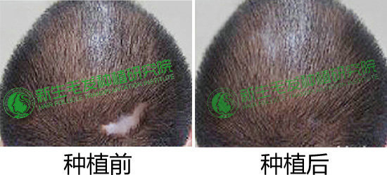 疤痕植发图册_360百科