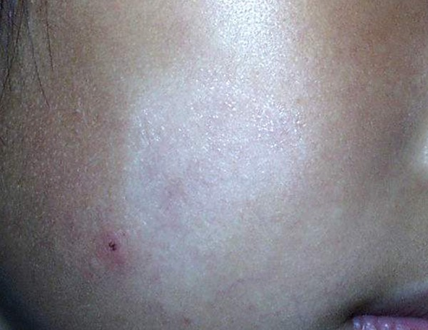 桃花癣图册_360百科