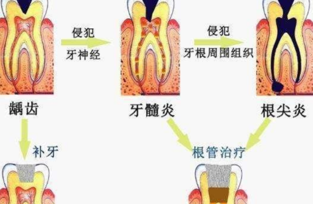 根管治疗分几个步骤_360新知