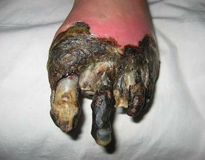 脱骨疽图册_360百科