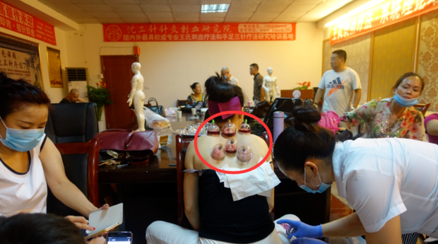 背部中医刺络放血疗法_360新知